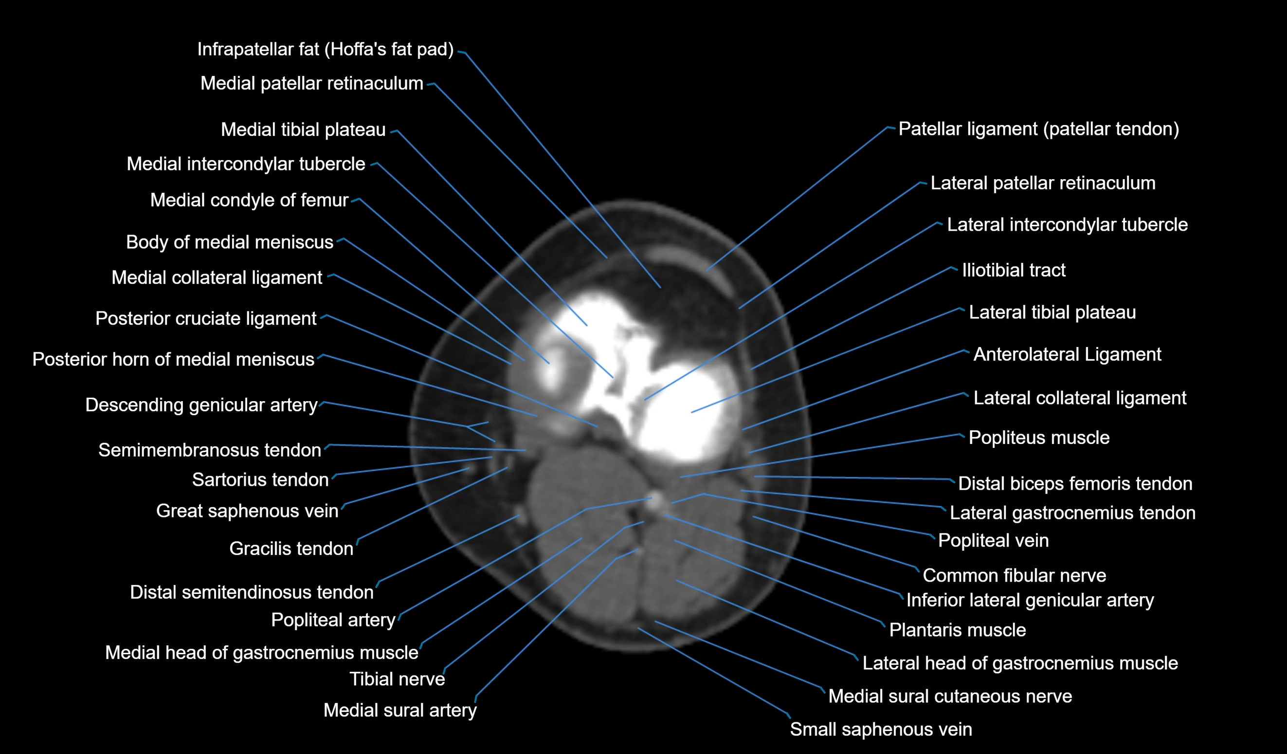 CT knee axial cross sectional anatomy labelled image-00037.webp